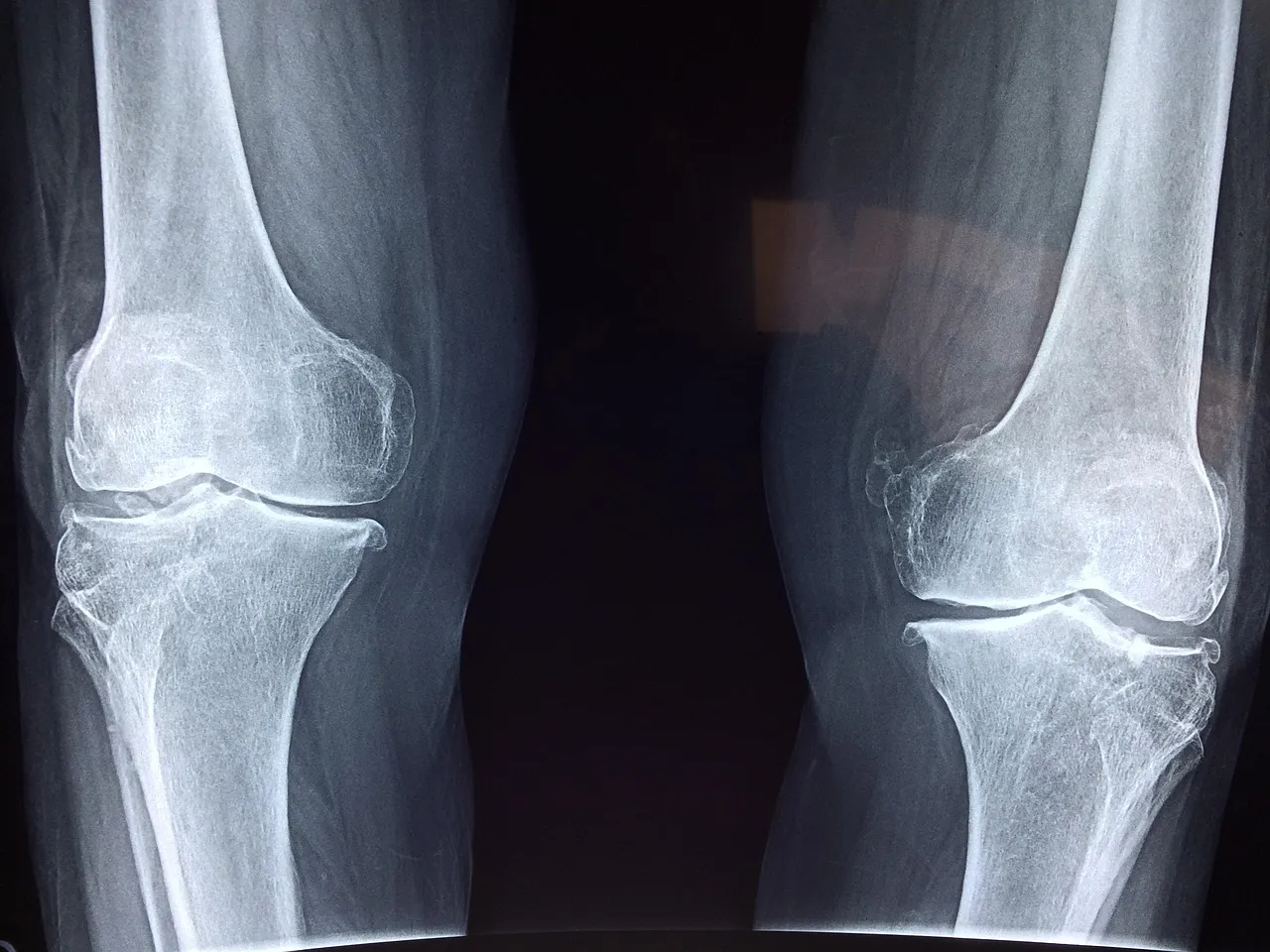 GLP-1s and Bone Density: An Open Question